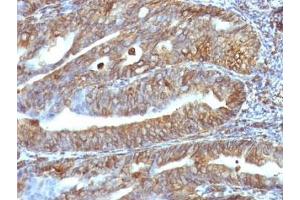 Immunohistochemistry (Formalin-fixed Paraffin-embedded Sections) (IHC (fp)) image for anti-Vimentin (VIM) antibody (ABIN3026904)