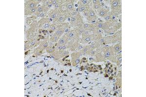 Immunohistochemistry of paraffin-embedded human liver injury using S100A12 antibody (ABIN5973068) at dilution of 1/100 (40x lens). (S100A12 anticorps)