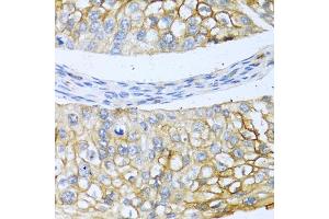 Immunohistochemistry of paraffin-embedded human prostate cancer using BMP4 antibody (ABIN5997308) at dilution of 1/100 (40x lens). (BMP4 anticorps)