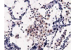 Immunohistochemical staining of paraffin-embedded Carcinoma of Human lung tissue using anti-OSBPL11 mouse monoclonal antibody. (OSBPL11 anticorps)