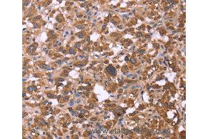 Immunohistochemistry of Human liver cancer using FBXW7 Polyclonal Antibody at dilution of 1:30 (FBXW7 anticorps)