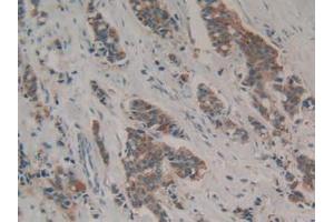 IHC-P analysis of Human Breast Cancer Tissue, with DAB staining. (GAL3ST1 anticorps  (AA 57-196))