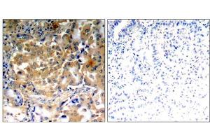 Immunohistochemical analysis of paraffin-embedded human lung carcinoma tissue using PKCζ (Phospho-Thr410) antibody (E011314). (PKC zeta anticorps  (pThr410))