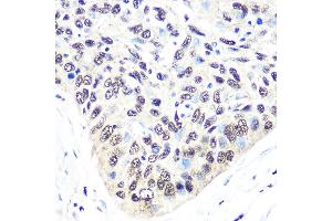 Immunohistochemistry of paraffin-embedded human esophageal cancer using Exportin 5 (XPO5) (XPO5) Rabbit mAb (ABIN1682763, ABIN3018126, ABIN3018127 and ABIN7101577) at dilution of 1:100 (40x lens). (XPO5 anticorps)