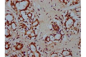 IHC image of ABIN7155703 diluted at 1:300 and staining in paraffin-embedded human breast cancer performed on a Leica BondTM system. (HMX2 anticorps  (AA 1-150))