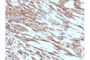 Formalin-fixed, paraffin-embedded human leiomyosarcoma stained with pan Muscle Actin antibody (MSA/953) (Pan Muscle Actin anticorps)