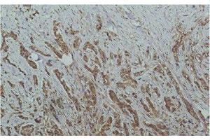 Immunohistochemistry of paraffin-embedded Human breast carcinoma tissue using HDAC1 Monoclonal Antibody at dilution of 1:200. (HDAC1 anticorps)