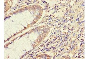 Immunohistochemistry of paraffin-embedded human colon cancer using ABIN7145091 at dilution of 1:100 (ATG5 anticorps  (AA 5-272))
