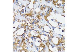 Immunohistochemistry of paraffin-embedded human breast cancer using RARα antibody (ABIN7269946) at dilution of 1:100 (40x lens). (Retinoic Acid Receptor alpha anticorps)