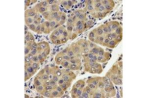 Immunohistochemical analysis of UQCRC2 staining in human liver cancer formalin fixed paraffin embedded tissue section. (UQCRC2 anticorps)