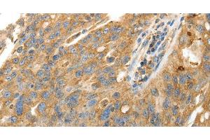 Immunohistochemistry of paraffin-embedded Human ovarian cancer using CALR Polyclonal Antibody at dilution of 1:50 (Calreticulin anticorps)