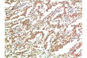 Immunohistochemical analysis of paraffin-embedded Human Lung Carcinoma Tissue using JAK2 Mouse mAb diluted at 1:200. (JAK2 anticorps)