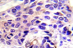 Immunohistochemistry (IHC) analyzes of p-GSK3alpha antibody in paraffin-embedded human breast carcinoma tissue. (GSK3 alpha anticorps  (pSer21))