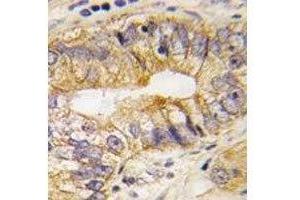 IHC analysis of FFPE human prostate carcinoma tissue stained with PDGFRA antibody (PDGFRA anticorps  (AA 746-775))