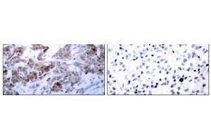 Immunohistochemical analysis of paraffin-embedded human breast carcinoma tissue using BCL-2 (Ab-70) antibody (E021060). (Bcl-2 anticorps)