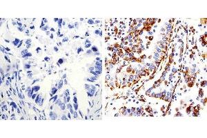 Immunohistochemistry analysis of Connexin 43 showing staining in the membrane of paraffin-embedded human lung adenocarcinoma (right) compared to a negative control without primary antibody (left). (Connexin 43/GJA1 anticorps  (C-Term))