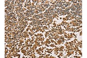 The image on the left is immunohistochemistry of paraffin-embedded Human tonsil tissue using ABIN7131042(SETD2 Antibody) at dilution 1/40, on the right is treated with fusion protein. (SETD2 anticorps)