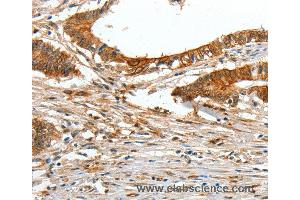 Immunohistochemistry of Human lung cancer using COL1A2 Polyclonal Antibody at dilution of 1:70 (COL1A2 anticorps)