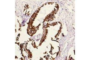 Immunohistochemical analysis of Cytokeratin 18 staining in human breast cancer formalin fixed paraffin embedded tissue section. (Cytokeratin 18 anticorps)
