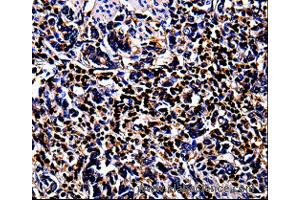 Immunohistochemistry of Human stomach cancer  using S100A4 Polyclonal Antibody at dilution of 1:100 (s100a4 anticorps)