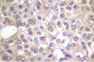 Immunohistochemistry (IHC) analyzes of p-PI3K p85 (pTyr458)/p55 (pTyr199) antibody in paraffin-embedded human breast carcinoma tissue. (PIK3R1 anticorps  (pTyr199, pTyr458))