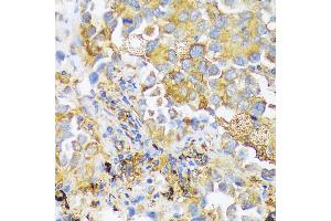 Immunohistochemistry of paraffin-embedded human lung cancer using ZDHHC18 antibody (ABIN7271549) at dilution of 1:100 (40x lens). (ZDHHC18 anticorps  (AA 301-388))