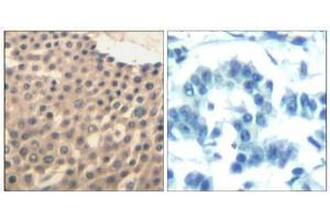 Immunohistochemical analysis of paraffin-embedded human lung carcinoma tissue using HDAC4/HDAC5/HDAC9 (Ab-246/259/220) Antibody (E021517). (HDAC4/HDAC5/HDAC9 anticorps)