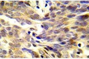 Immunohistochemistry (IHC) analyzes of p-BRCA1 antibody in paraffin-embedded human lung adenocarcinoma tissue. (BRCA1 anticorps  (pSer1423))
