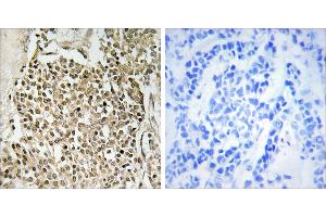 Peptide - +Immunohistochemistry analysis of paraffin-embedded human breast carcinoma tissue using CEP350 antibody. (CEP350 anticorps)