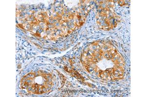 Immunohistochemistry of Human thyroid cancer using AIP Polyclonal Antibody at dilution of 1:80 (AIP anticorps)