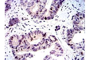 Immunohistochemical analysis of paraffin-embedded colon cancer tissues using BIRC5 mouse mAb with DAB staining. (Survivin anticorps)