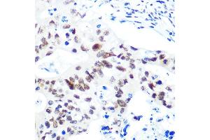 Immunohistochemistry of paraffin-embedded human colon carcinoma using HD Rabbit mAb (ABIN1680476, ABIN3015870, ABIN3015871 and ABIN7101453) at dilution of 1:100 (40x lens). (HDAC9 anticorps)