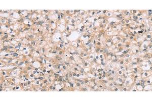 Immunohistochemistry of paraffin-embedded Human prostate cancer tissue using ROR1 Polyclonal Antibody at dilution 1:45 (ROR1 anticorps)