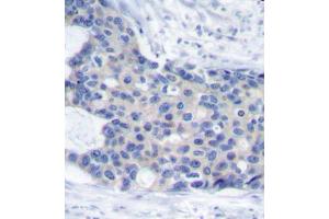 Immunohistochemistry of paraffin-embedded human breast carcinoma tissue, using Phospho-ZAP70-Y493 antibody (ABIN2988352). (ZAP70 anticorps  (pTyr493))