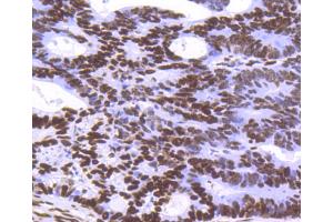 Paraformaldehyde-fixed, paraffin embedded Human breast carcinoma tissue, Antigen retrieval by boiling in sodium citrate buffer (pH6) for 15min, Block endogenous peroxidase by 3% hydrogen peroxide for 30 minutes, Blocking buffer at 37°C for 20min, Antibody incubation with Histone H3. (Histone H3.3 anticorps)