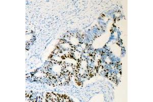 Immunohistochemical analysis of Androgen Receptor (pS650) staining in human prostate cancer formalin fixed paraffin embedded tissue section. (Androgen Receptor anticorps  (pSer650))
