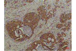 Immunohistochemical analysis of paraffin-embedded Human Breast Carcinoma using P44/42 MAPK (ERK1/2) Mouse mAb diluted at 1:200. (ERK1/2 anticorps)