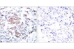 Immunohistochemistry analysis of paraffin-embedded human breast carcinoma tissue, using STAT5A (Ab-694) Antibody. (STAT5A anticorps  (AA 666-715))