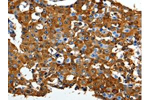 The image on the left is immunohistochemistry of paraffin-embedded Human breast cancer tissue using ABIN7191316(LRP1 Antibody) at dilution 1/90, on the right is treated with synthetic peptide. (LRP1 anticorps)