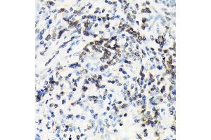Immunohistochemistry of paraffin-embedded human lung cancer using CSK Rabbit mAb (ABIN1513217, ABIN3021034, ABIN3021035 and ABIN7101334) at dilution of 1:100 (40x lens). (CSK anticorps)