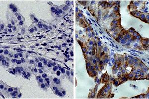 Paraffin embedded human gastric cancer tissue was stained with Mouse IgG2a-HRP isotype control followed by DAB and hematoxylin. (KRT8 anticorps  (HRP))