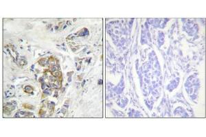 Immunohistochemical analysis of paraffin-embedded human breast carcinoma tissue, using ITGB4 (Phospho-Tyr1510) antibody (left)or the same antibody preincubated with blocking peptide (right). (Integrin beta 4 anticorps  (pTyr1510))