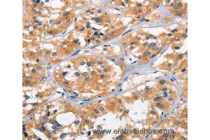 Immunohistochemistry of Human cervical cancer using AHR Polyclonal Antibody at dilution of 1:50 (Aryl Hydrocarbon Receptor anticorps)