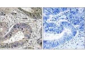 Immunohistochemistry analysis of paraffin-embedded human colon carcinoma tissue, using ERN2 Antibody. (ERN2 anticorps  (AA 841-890))