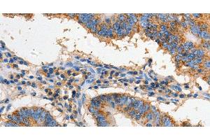 Immunohistochemistry of paraffin-embedded Human colon cancer using FAS Polyclonal Antibody at dilution of 1:60 (FAS anticorps)