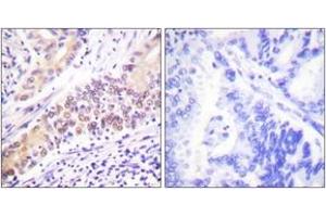 Immunohistochemistry analysis of paraffin-embedded human lung carcinoma tissue, using TOP2B Antibody. (TOP2B anticorps  (AA 1-50))