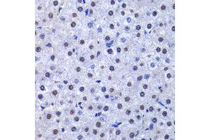 Immunohistochemistry of paraffin-embedded human liver cancer using GSTP1 antibody at dilution of 1:200 (400x lens). (GSTP1 anticorps)