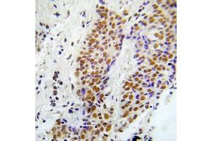 Immunohistochemical analysis of paraffin-embedded human lung adenocarcinoma tissue using ASK1 (Phospho-Ser966) Antibody (E012059). (ASK1 anticorps  (pSer966))