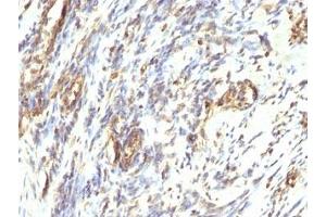 Immunohistochemistry (Formalin-fixed Paraffin-embedded Sections) (IHC (fp)) image for anti-Vimentin (VIM) antibody (ABIN3026904)