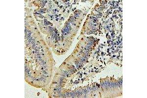 Immunohistochemical analysis of IL-27 staining in human colon cancer formalin fixed paraffin embedded tissue section. (IL-27 anticorps)